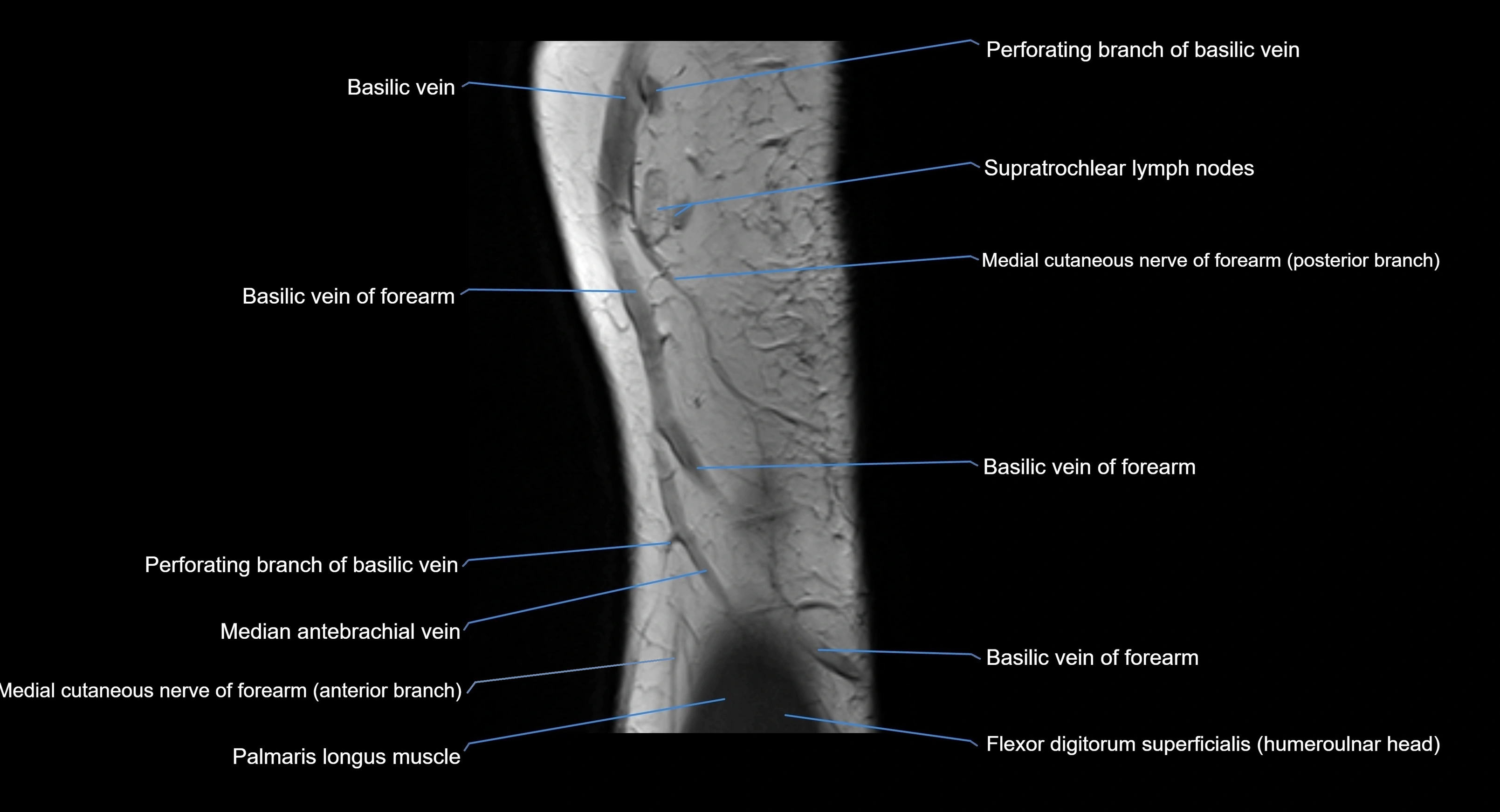 MRI elbow joint  sagittal cross sectional anatomy 3T  radiology  image-img-00001-00004.webp